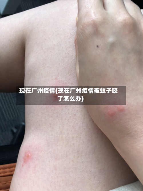 现在广州疫情(现在广州疫情被蚊子咬了怎么办)-第3张图片