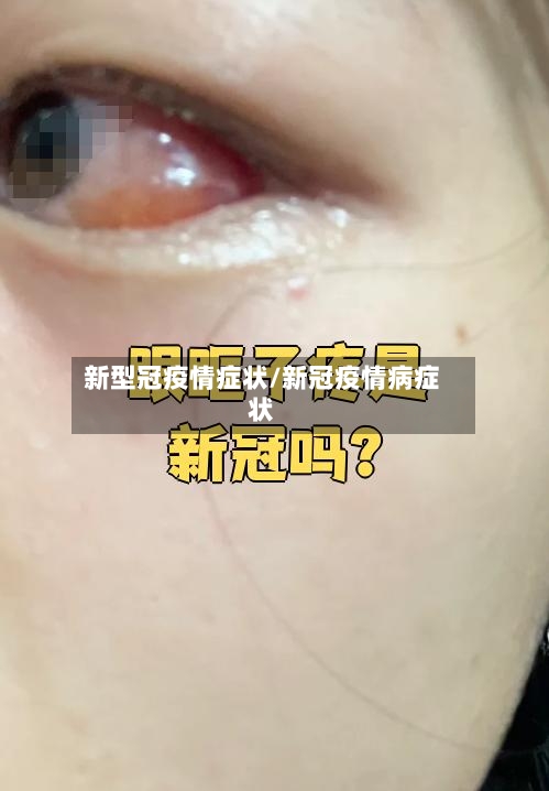新型冠疫情症状/新冠疫情病症状-第1张图片