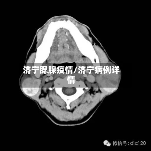 济宁腮腺疫情/济宁病例详情-第1张图片