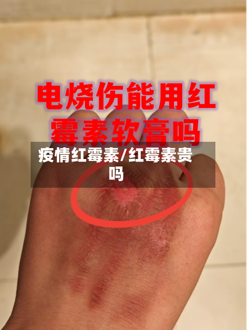 疫情红霉素/红霉素贵吗-第1张图片